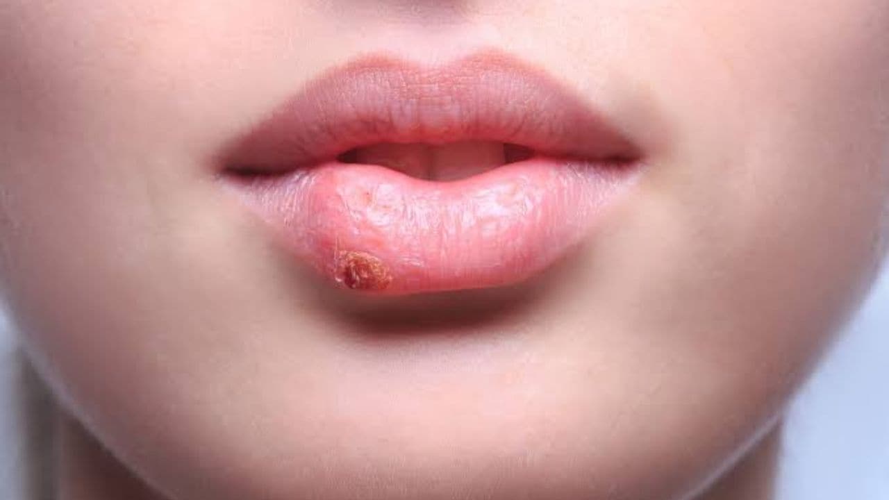 Lip Cancer