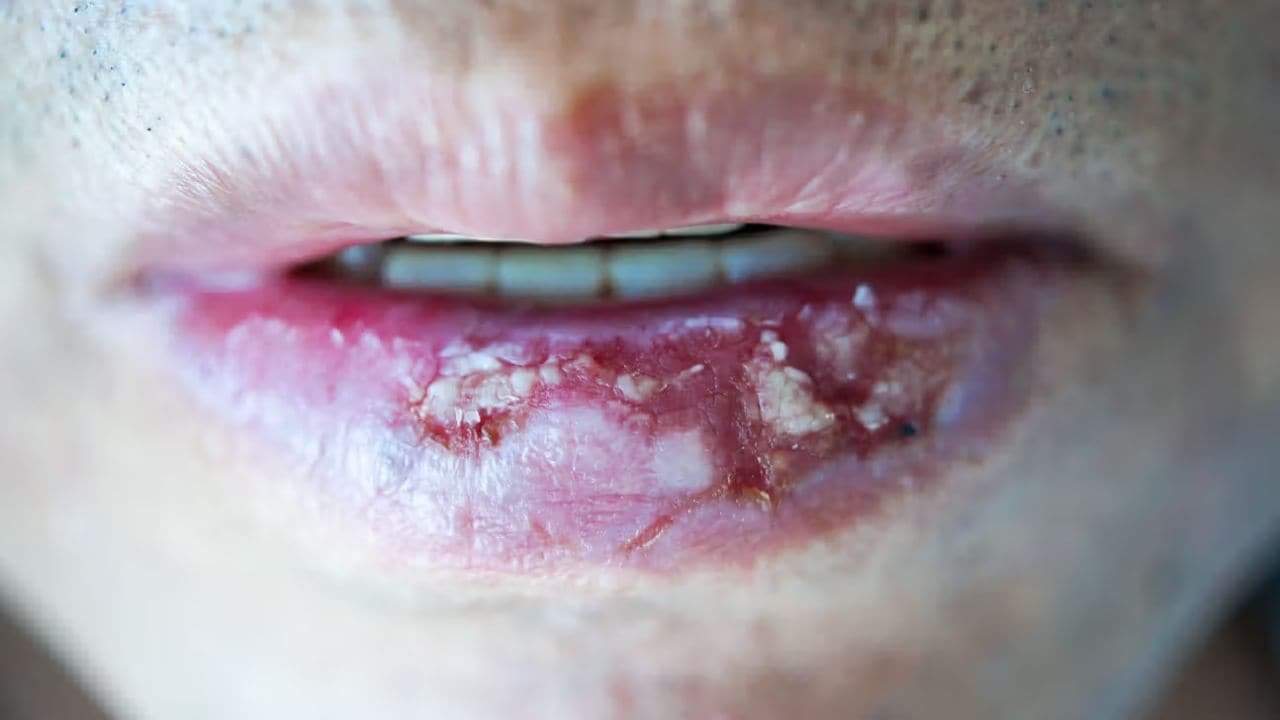 Lip Cancer