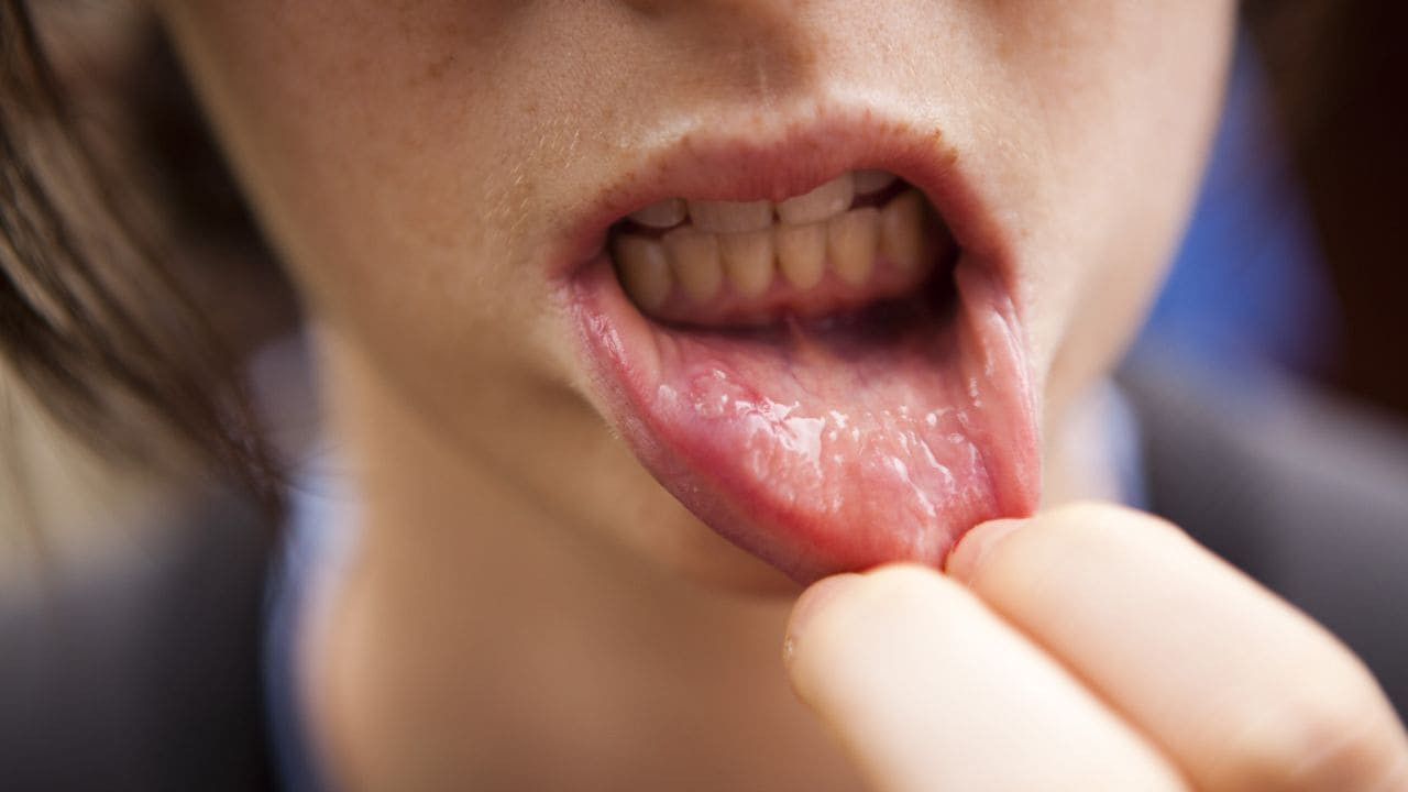 Lip Cancer