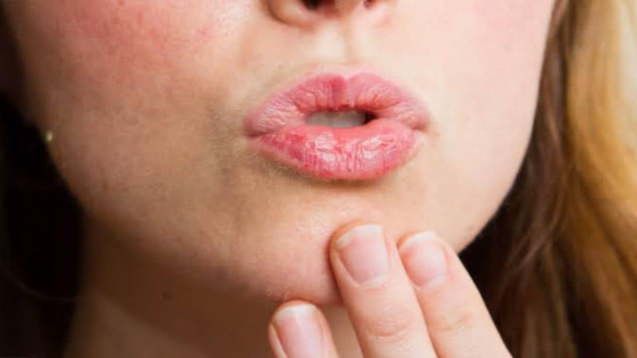 Lip Cancer